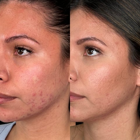 Before and after comparison of skin treatment showing reduced redness and acne on womans face