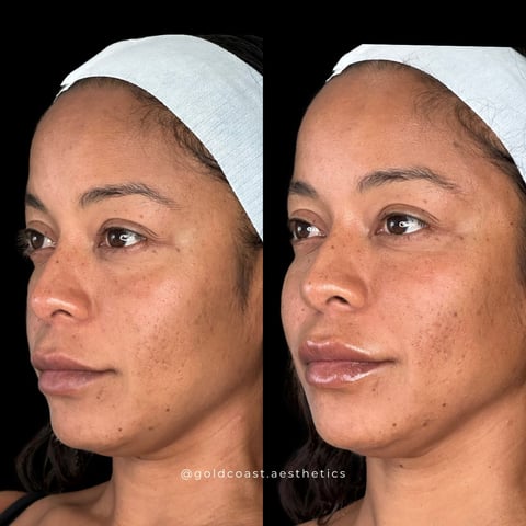 Before and after comparison of facial skin treatment results showing improved complexion and reduced blemishes on a womans face