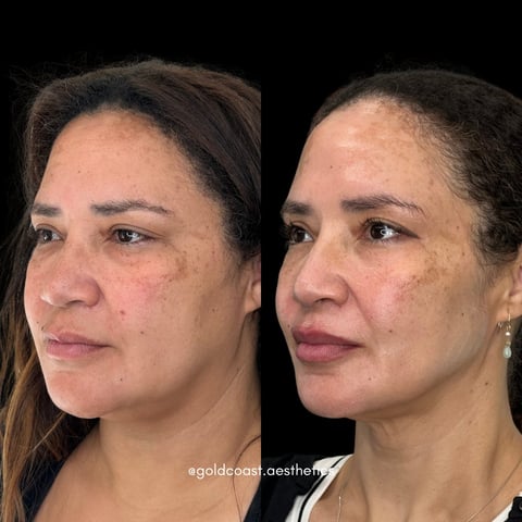 Before and after cosmetic treatment comparison showing side profile of womans face with improved skin texture and facial definition