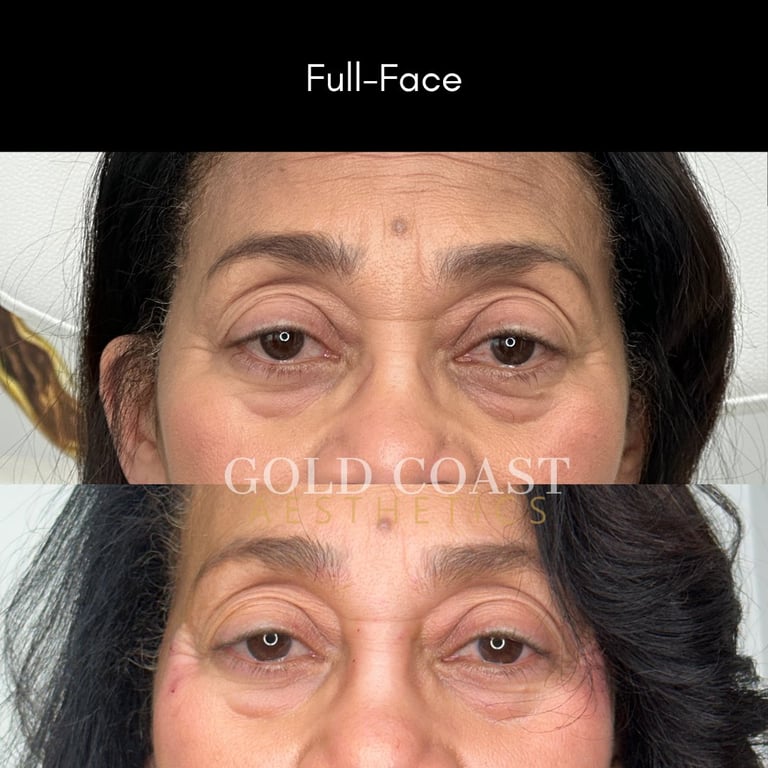 Before and after full-face comparison showing reduced under-eye bags and improved skin texture
