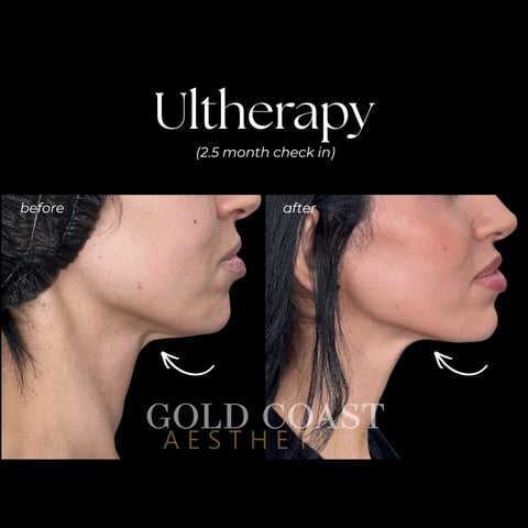 Before and after side profile comparison of Ultherapy treatment results at 2.5 months, showing improved jawline definition and skin tightening