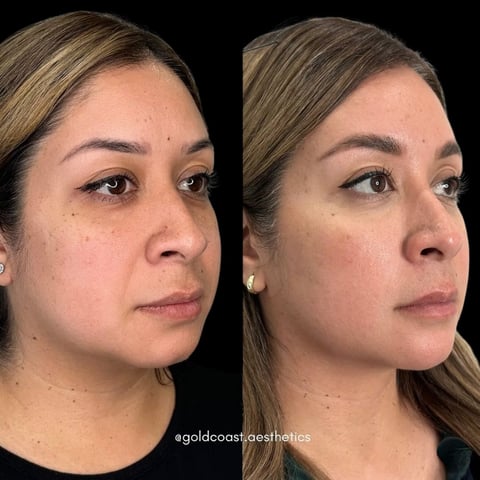 Before and after comparison of facial treatment results showing reduced dark circles and improved skin texture on a womans face
