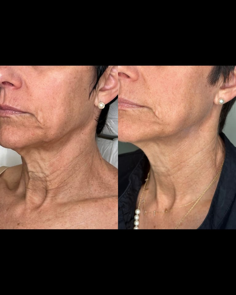 Before and after comparison photos of a womans neck and jawline showing skin tightening results