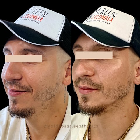 Before and after side profile comparison of a man wearing a white and black Colombia cap with gold chain necklace against black background