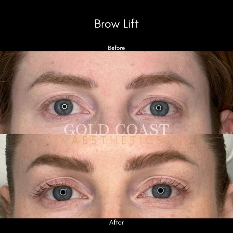 Before and after brow lift procedure showing lifted eyebrows with improved arch and eye opening.