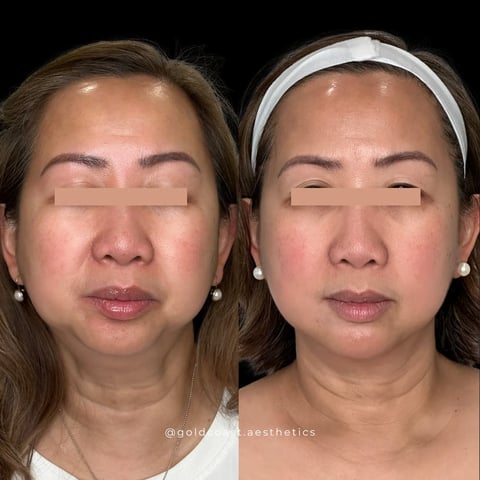 Before and after facial aesthetics comparison showing two women with smoother, more lifted skin appearance on the right side