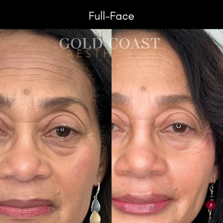 Before and after facial comparison showing full-face aesthetic treatment results, displaying skin texture and wrinkle reduction