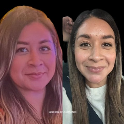 Side-by-side comparison of two women showing before and after results of cosmetic procedures or makeup application