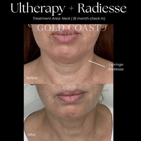 Before and after neck treatment using Ultherapy and Radiesse showing improved skin texture and reduced sagging at 6 month check-in