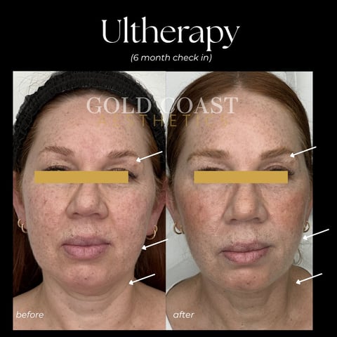Before and after comparison of Ultherapy facial treatment at 6 months, showing skin tightening results on lower face and jawline areas