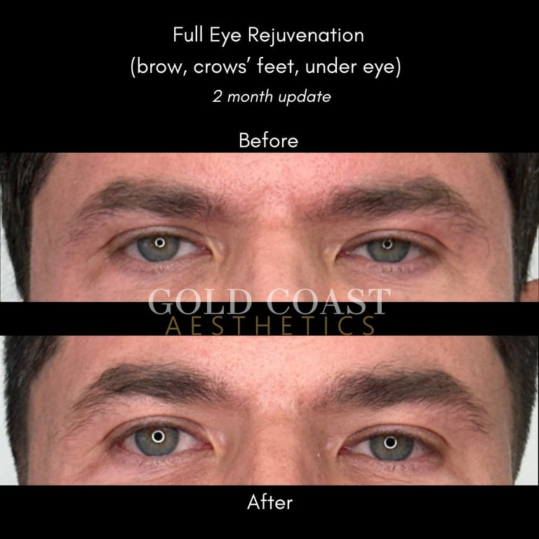 Before and after comparison of full eye rejuvenation treatment showing reduced brow lines, crows feet, and under-eye bags at 2 months