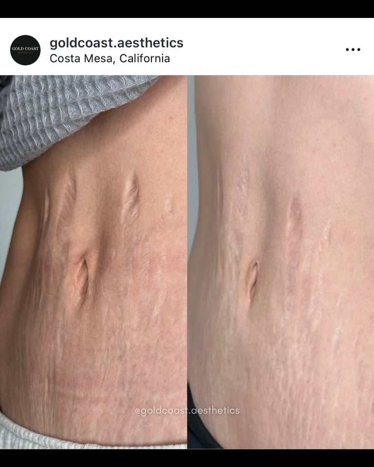 Before and after comparison of stretch mark treatment on torso, showing reduced appearance of stretch marks on skin
