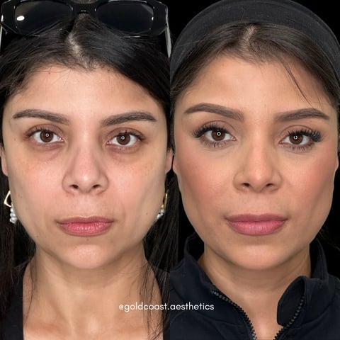 Before and after facial aesthetic treatment showing reduced under-eye darkness and improved skin texture