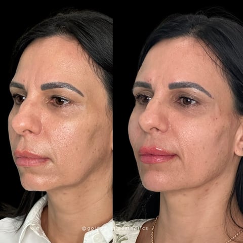 Before and after comparison of facial treatment showing improved lip volume and skin texture on right side