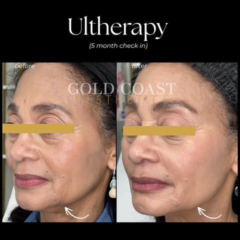 Before and after comparison of Ultherapy treatment results on a womans face at 5 month check-in, showing skin tightening improvements
