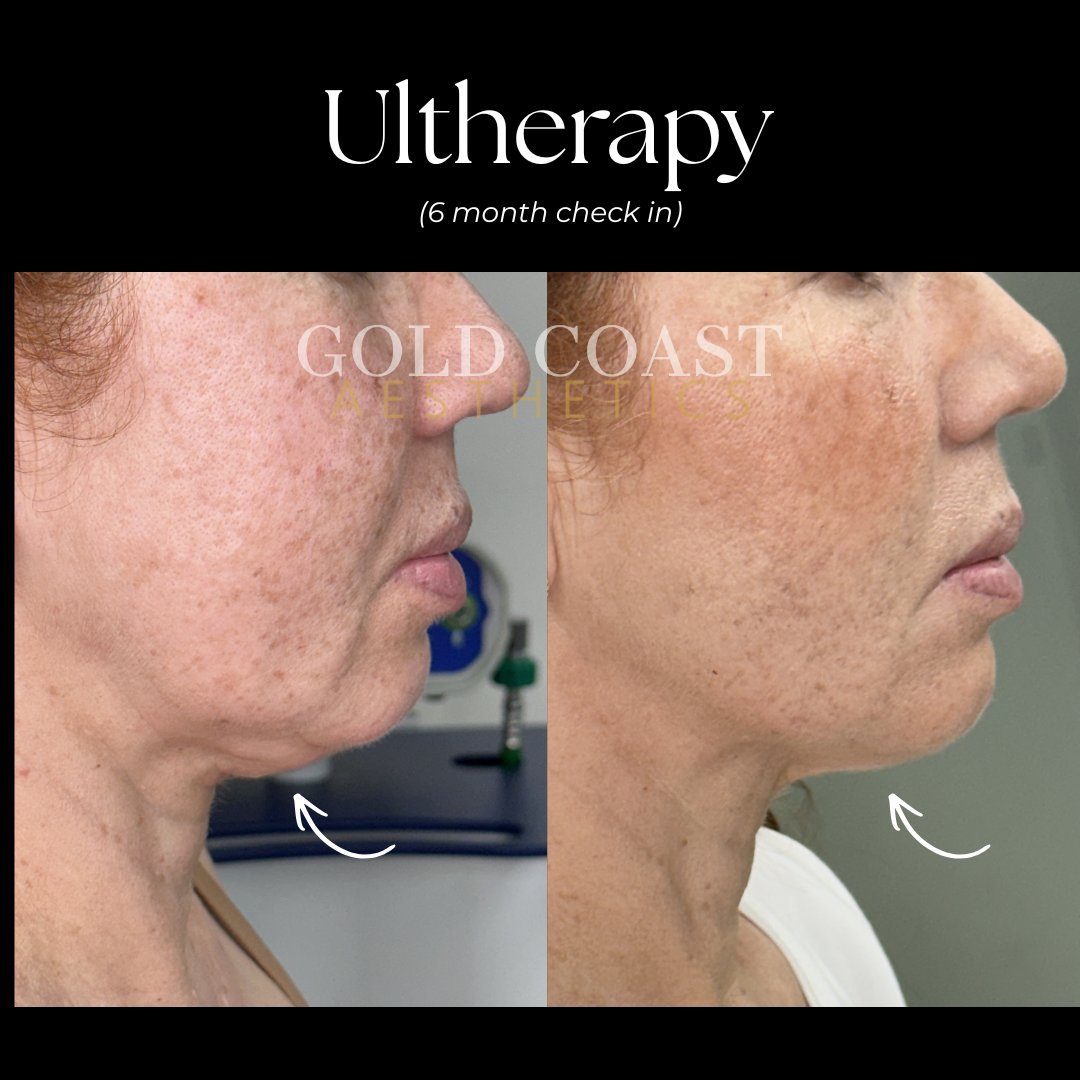 Ultherapy Prime before and after result