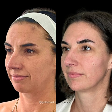 Before and after facial comparison showing skin texture and appearance changes on a womans face
