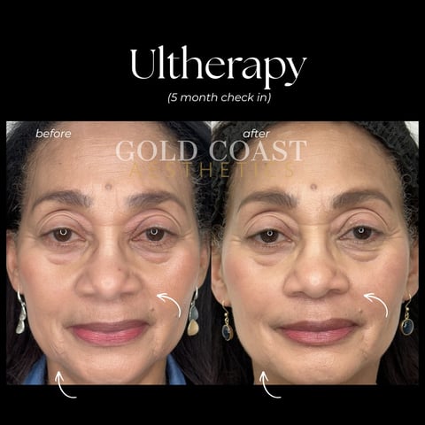 Ultherapy before and after results at 5 month check-in showing facial skin tightening on Gold Coast patient
