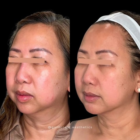 Before and after comparison of facial contouring treatment showing reduced facial puffiness and improved definition on right side