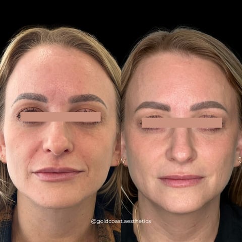 Before and after facial comparison showing skin rejuvenation results on two women with eyes closed