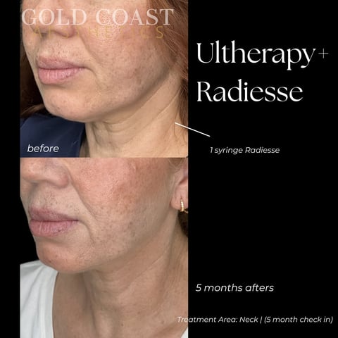 Before and after photos showing skin improvement on neck and jawline after Ultherapy and Radiesse treatment at 5 months.