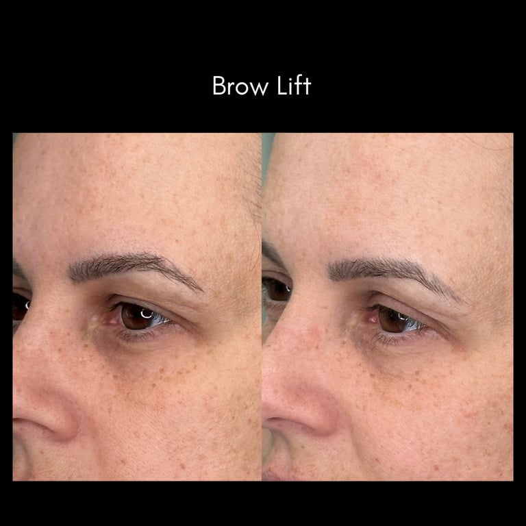 Before and after comparison of brow lift results, showing lifted eyebrows on the right side