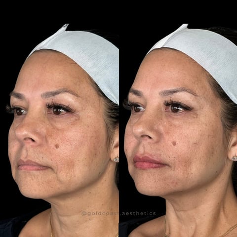 Before and after facial treatment comparison showing reduced wrinkles and improved skin texture on a womans face