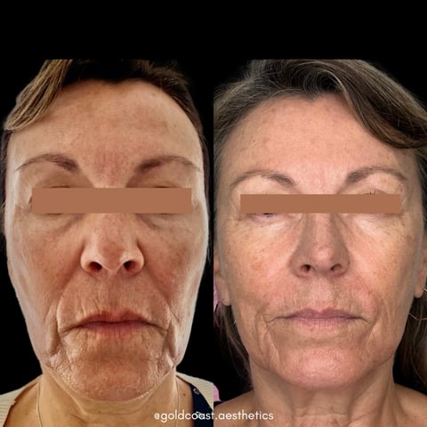 Before and after facial treatment comparison showing skin rejuvenation results on a womans face against black background