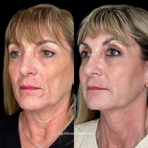 Before and after cosmetic treatment comparison showing two facial profile views of a woman