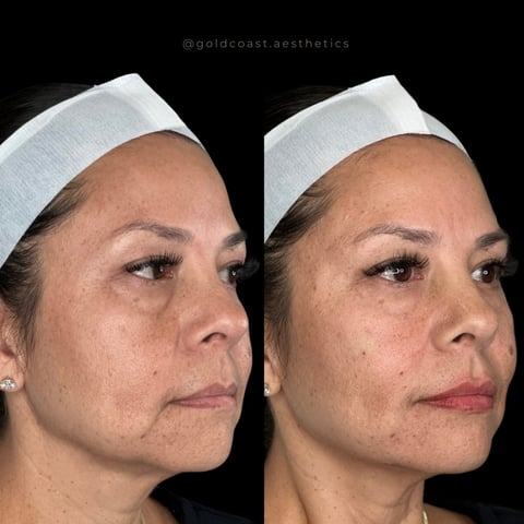 Before and after side profile comparison of facial skin treatment showing reduced wrinkles and improved skin texture