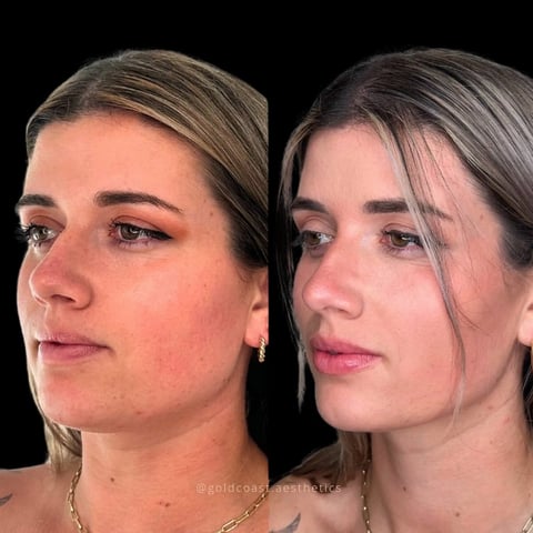 Before and after facial profile comparison showing changes in skin appearance and definition on black background