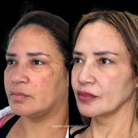 Before and after facial treatment comparison showing skin improvement, side-by-side profile views