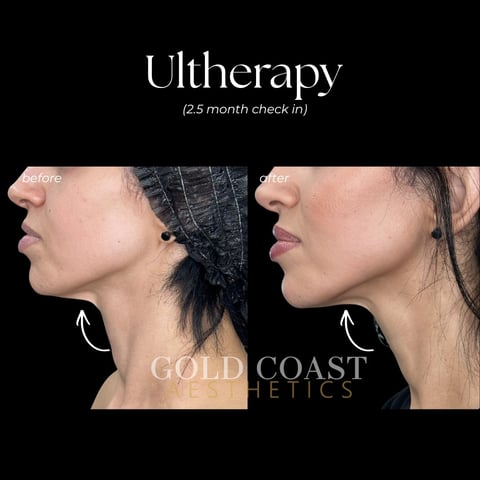 Before and after side profile comparison of Ultherapy results at 2.5 month check-in showing improved jawline definition and skin tightness