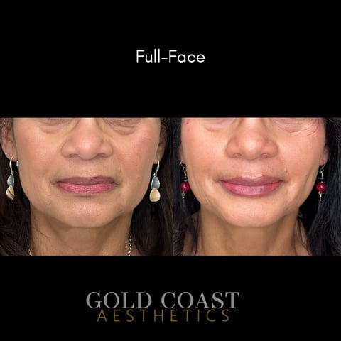 Before and after full-face aesthetic treatment comparison by Gold Coast Aesthetics, showing facial rejuvenation results
