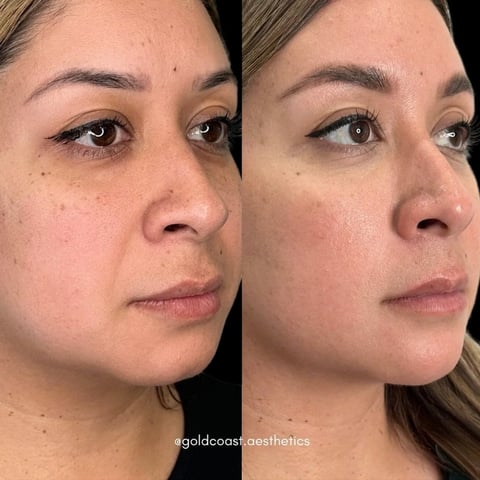 Before and after comparison of skin treatment results showing reduced wrinkles and improved skin texture on female face