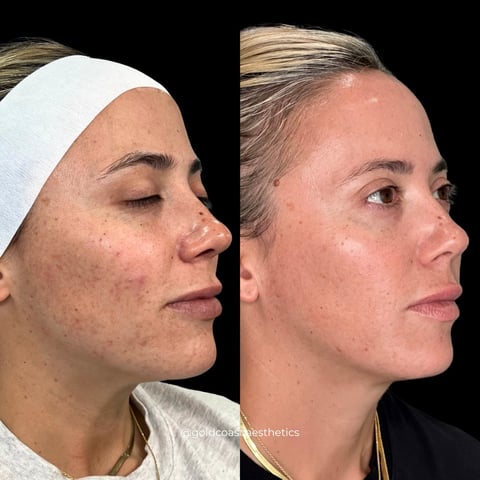 Before and after side profile comparison of facial skin treatment showing reduced blemishes and improved skin texture