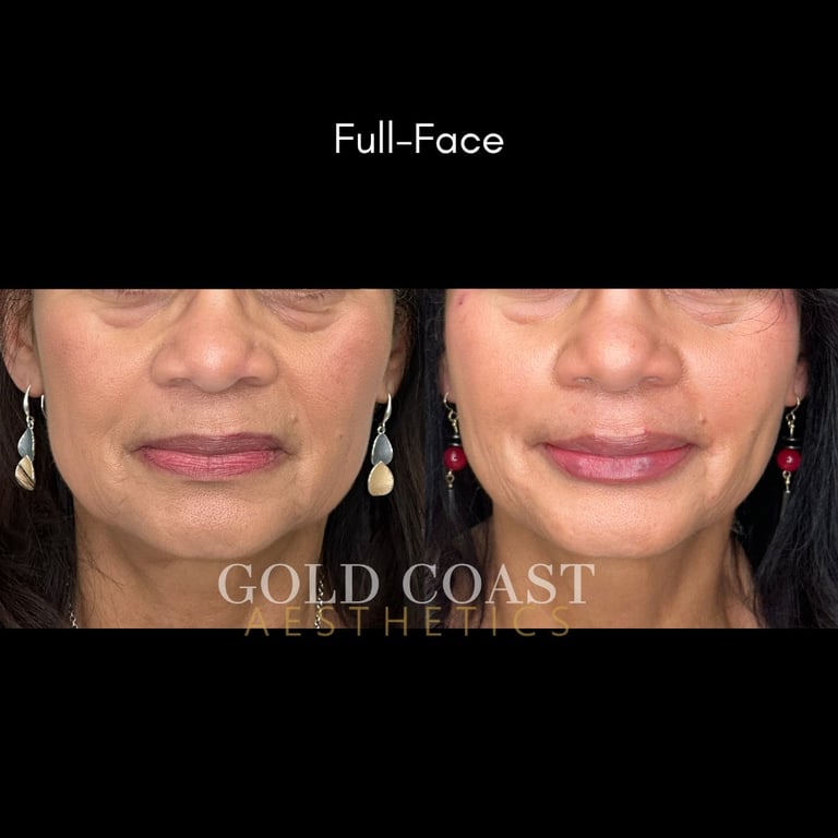 Before and after full-face cosmetic treatment results showing facial skin improvement at Gold Coast Aesthetics clinic