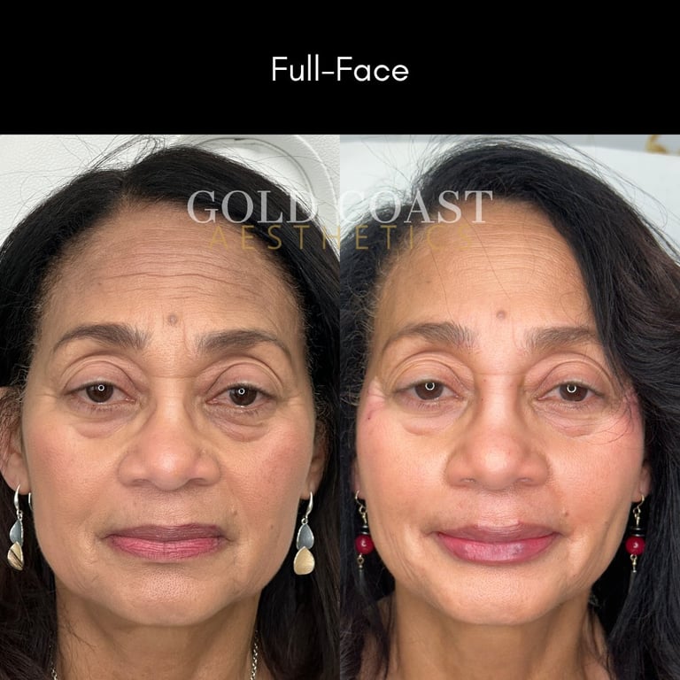 Before and after full-face comparison showing results of cosmetic treatment on womans face
