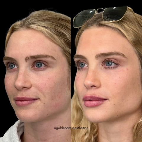 Before and after cosmetic treatment showing profile comparison of womans face with improved skin texture and definition