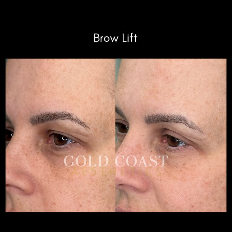 Before and after brow lift results showing elevated eyebrows on female patient, Gold Coast clinic branding