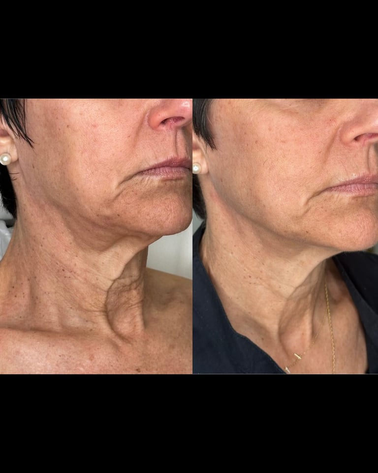 Before and after comparison of neck skin, showing improved texture and firmness on the right side