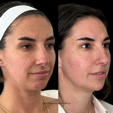 Before and after comparison of womans face showing skin texture and complexion improvement