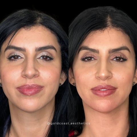 Before and after comparison of lip augmentation procedure showing fuller lips on the right side
