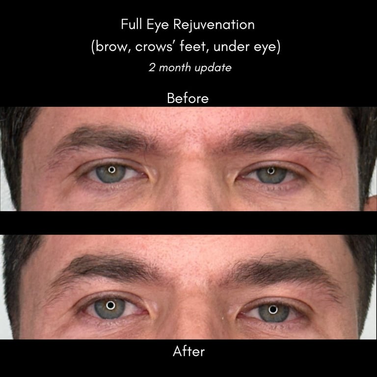 Before and after comparison of full eye rejuvenation treatment showing reduced wrinkles and improved skin texture around brows and eyes after 2 months