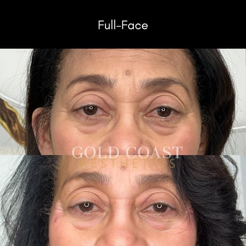 Before and after full-face treatment comparison showing reduced under-eye puffiness and improved skin texture