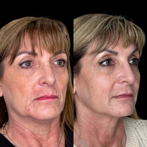 Before and after photos of a womans face showing skin texture and appearance changes