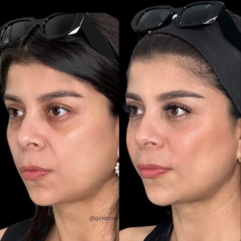 Before and after comparison of womans face showing cosmetic results, with sunglasses pushed up on head