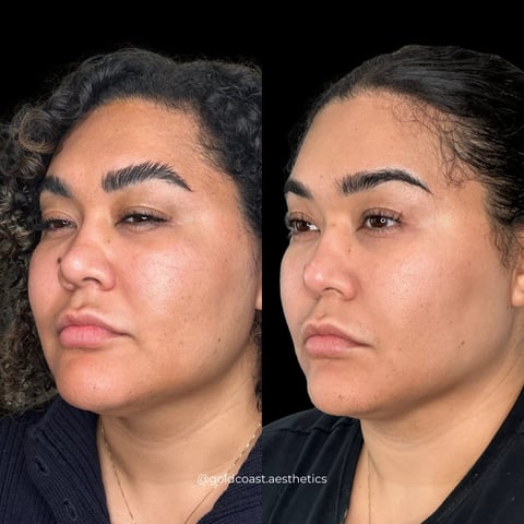 Before and after facial profile comparison showing cosmetic treatment results on a womans face