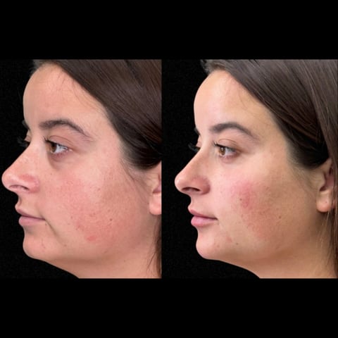 Before and after comparison of womans face showing facial skin improvement with reduced redness and smoother complexion