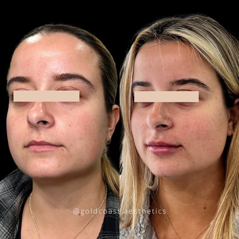 Before and after comparison of facial rejuvenation treatment showing two women with eyes censored, displaying results of cosmetic procedure